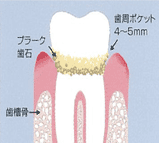 軽度歯周病（P1）
