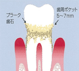 中度歯周病（P2）