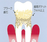 重度歯周病（P3）